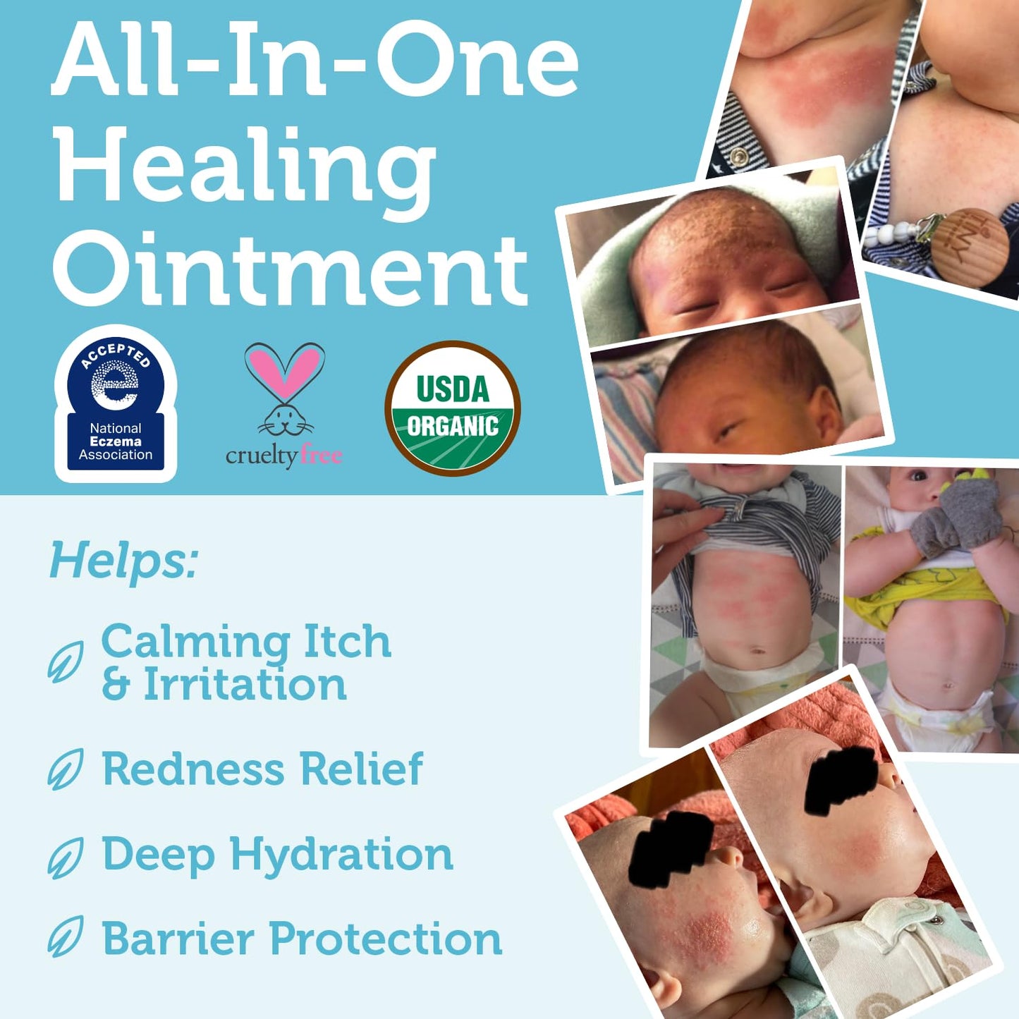 Era Organics Healing Ointment for Babies - USDA Certified Organic Natural Moisturizer Gentle on Sensitive Skin Prone To Baby Eczema, Cradle Cap (Infant Seborrheic Dermatitis), Rashes, Hives and More