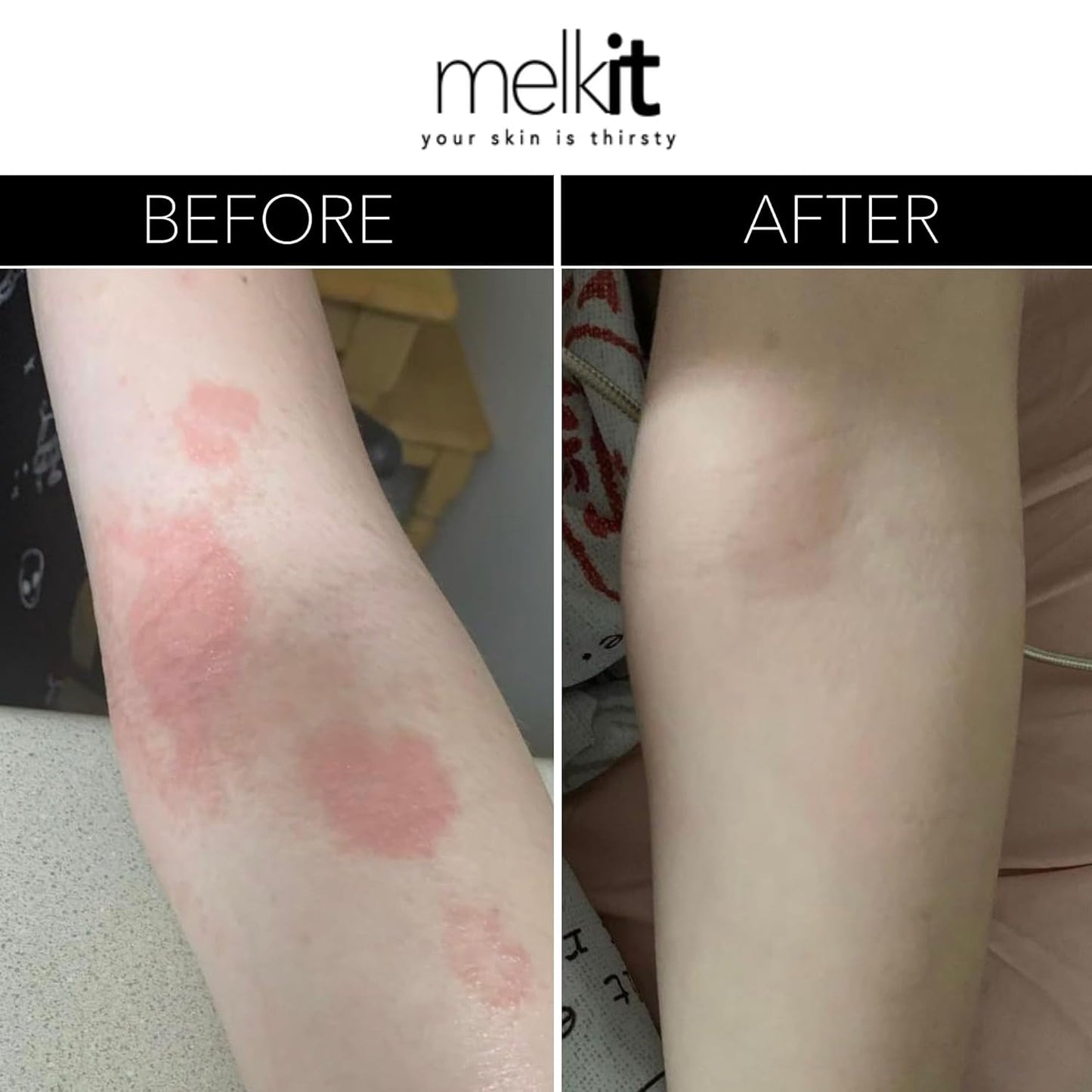 Body Melk Natural Body Cream - All Over Fast-Absorbing Hydration for Dry or Sensitive Skin - Soothe Sensitive Skin, Rash & Irritation - All Skin Types - 16 oz