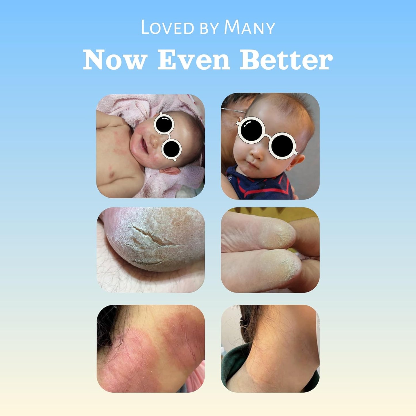 Natural SKIN REPAIR. Clinically tested Aromatherapy. Powerful Essential Oil. Eczema, Dermatitis, Diaper rash, and Sensitive skin. For all skin types. Hypoallergenic, Vegan, Paraben Free. 30ML TUBE